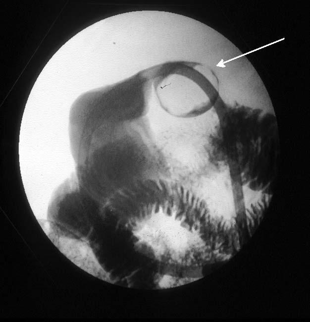 Figure 1 Barium contrast study revealing a polypoid-filling defect (arrow) in the duodenum Figure 2 Resection specimen measuring 4.5 x 2.8 x 2.4 cm DISCUSSION Benign tumours of the duodenum are rare.