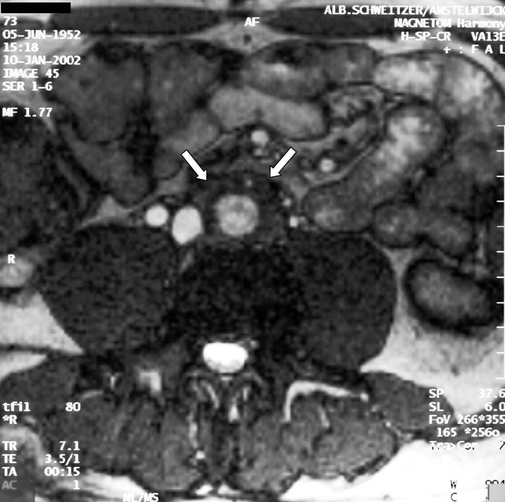 Figure 3 T 1 -weighted MR imaging Showing a well-demarcated periaortic mass with