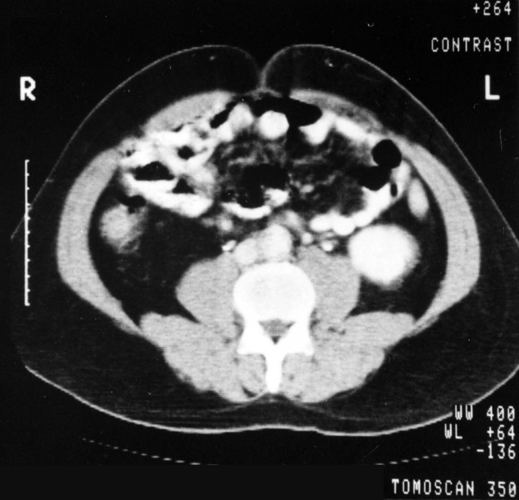 complete disappearance of the retroperitoneal mass.