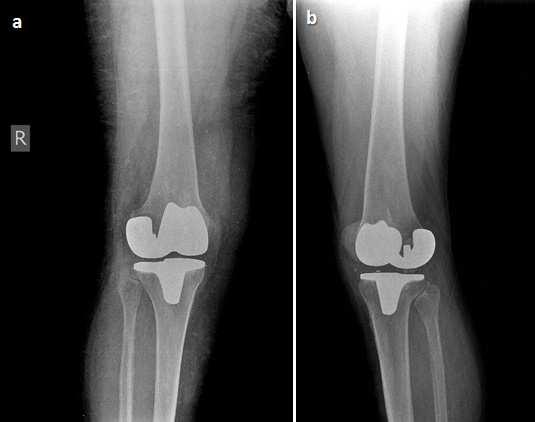 276 Recent Advances in Hip and Knee Arthroplasty proximal tibiofibular and the knee joint occurs via the subpopliteal recess-associated defect in the posterior ligament of the fibular head (Dirim et