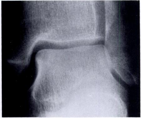 In nine patients, the staging of the fracture corresponded to the staging assigned after magnetic resonance imaging.