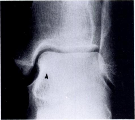 Unfortunately, there was a delay of three months before computerized tomography could be performed on the fifth patient (Case 1), during which time the fracture had progressed from Stage I to Stage
