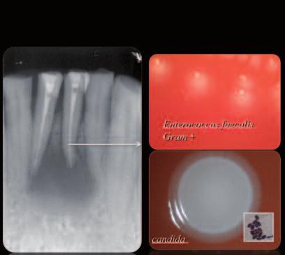 2,3 Clinically, apical periodontitis is not evident as long as the necrotic tissue is not infected with microorganisms. 4 6 There are up to 40 isolated species of bacteria present in the root canal.