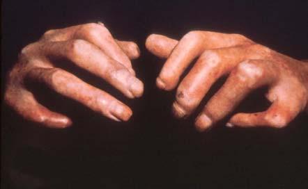 Advanced Sclerodactyly Gottron's Papules