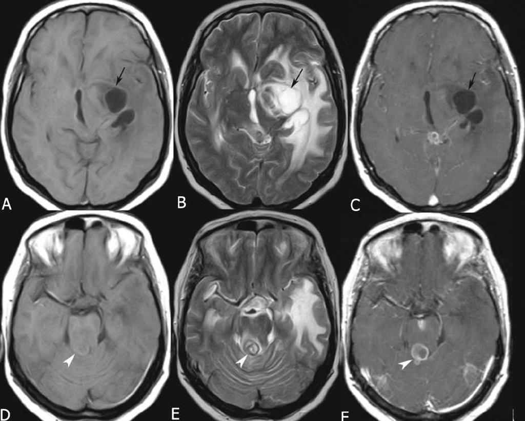 2 Tore et al. Fig. 1 Cryptococcus neoformans abscess in different regions of the brain. Interrelated cystic lesions (gelatinous pseudocyst) can be seen in the left basal ganglion.