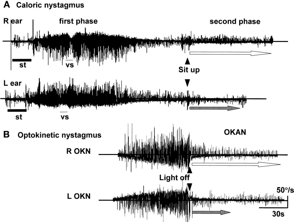 Caloric Second Phase, Positional Change, and Vertigo International Tinnitus Journal, Vol. 12, No. 2, 2006 Figure 1. Electronystagmography recording of the horizontal eye velocity (time constant [tc].