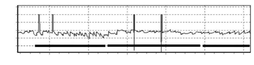 Korean J Otorhinolaryngol-Head Neck Surg 218;61(3):151-5 as hearing loss or fullness of the ear. Vertigo was relieved with rest, but it soon aggravated whenever the patient changed position.