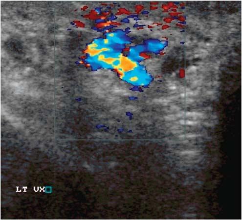 10 Human Andrology Figure 5 Figure 7 Testicular volume assessment by grey mode scrotal us. Varicocele picture showing venous reflux on color mode scrotal us.