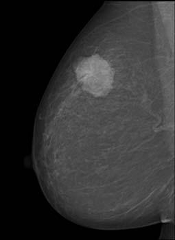 structures Maravilla KR, AJR 1983 Breast cancer is the most common malignancy in women Worldwide, breast cancer comprises 10.