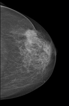 Mammography Typical findings: