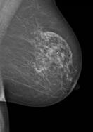 Nondetection of Cancer Breast