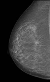 results for digital breast tomosynthesis We need more clinical
