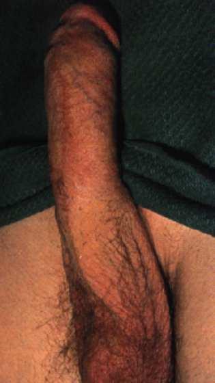 Priapism Priapism is a potentially painful medical condition in which the erect penis does not return to its flaccid state, despite the absence of both physical and psychological stimulation, within