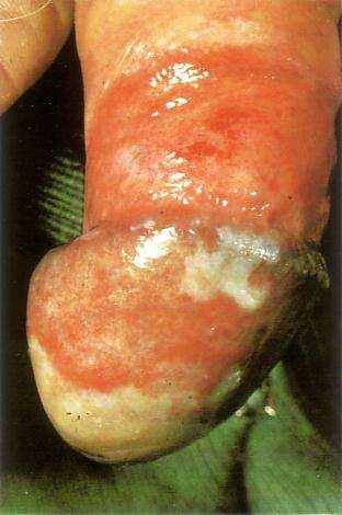 Balanitis Balanitisis inflammation of the glanspenis.