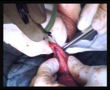 Dorsal Incision with graft interposition Penile