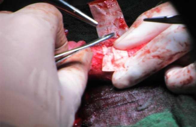 tunica albuginea and implantation of a graft
