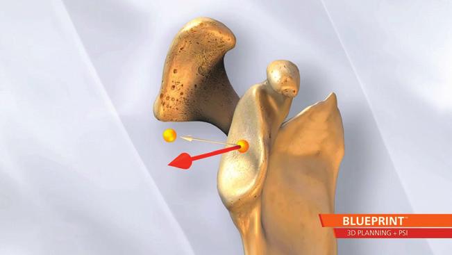 » In one study, D planning showed more accurate measurements of glenoid version in half the cases studied.