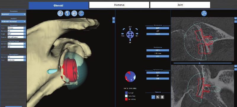 -D CONSTRUCT VISUALIZATION Understanding the patient s anatomy before the case with D landmarks» Planning with BLUEPRINT has been shown to change the choice of implant between anatomic and reversed