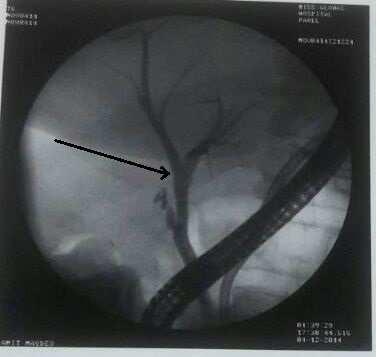 230 231 232 233 Figure 2: ERCP image showing dilated CBD (arrow) without
