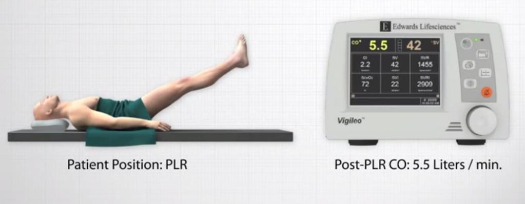 Passive leg raising (PLR) Volume of blood transferred (usually 200-300 ml) to the heart during PLR is sufficient to increase the left cardiac preload and thus challenge the