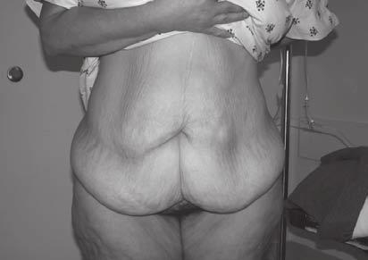 Abdominal Lipectomy: A Prospective Outcomes Study Figure 1. Preoperative photograph showing the excess abdominal wall pannus overlying the pubic area. Figure 2.