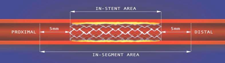 In-Stent Restenosis Patterns
