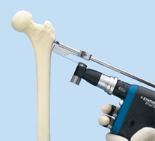 Perform Osteotomy 6 Perform osteotomy Instruments 332.173 Cannulated Chisels 332.175 332.20 Slotted Hammer 332.354, Saw Guides 332.355 or 332.