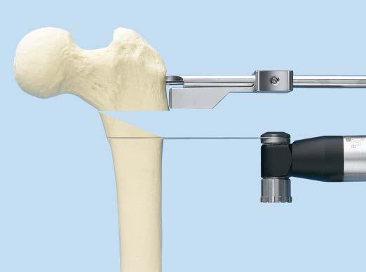Insert rotation guide wires above and below the osteotomy site in a manner that will not interfere with plate placement. Protect the medial soft tissues with retractors.