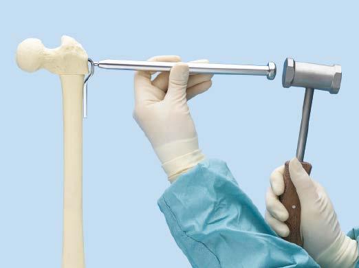Insert the selected osteotomy plate by hand, ensuring that the plate follows the path created by the chisel.
