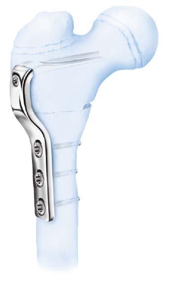Cannulated Pediatric Osteotomy System (CAPOS) The Cannulated Pediatric Osteotomy System (CAPOS) combines implants and instruments in one convenient system.