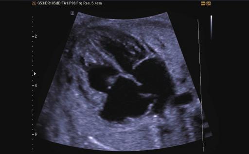 Fetal heart with multi OVIX