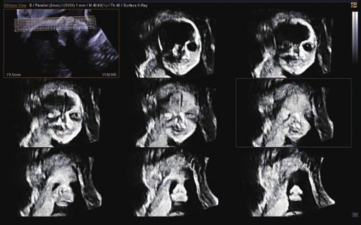 Early Fetus 3D with VSI