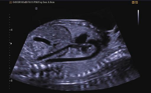 Adenomyosis Fetal spine with