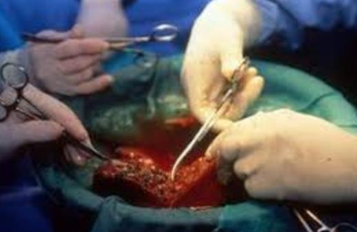 Cirrhosis Transplantation 20 to 30 Years