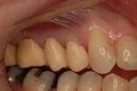 impression Decision on final restorations + Prep refinement + Laboratory Provisionals Tooth reduction based on outer form of
