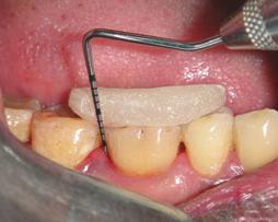 2 Laser assisted periodontal pocket therapy.