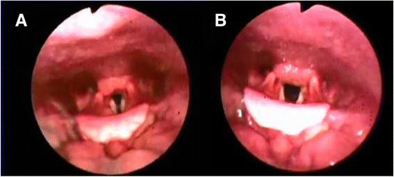 Flexible Laryngoscopy A. Paradoxical vocal cord motion with inspiration B.