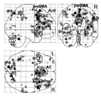 J Neurophysiol 2002;88:1500-1511 Air Hunger Increases MRI Signal in Insula (Limbic System) Insula Insula (Limbic System): -Perception of dyspnea, hunger, thirst
