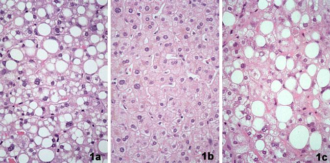 Expression of liver steatosis in HCV infection and pattern of response to α-interferon Liver steatosis in a patient with recurrent hepatitis C after LT, before α-ifn therapy