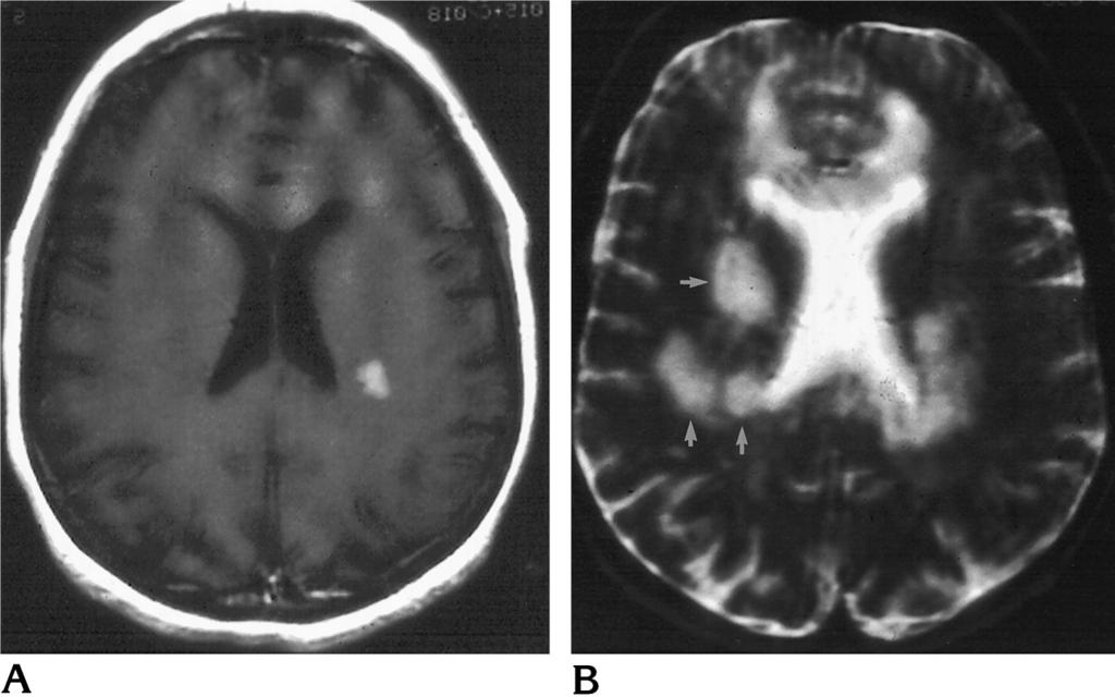 AJNR: 18, March 1997 PRIMARY CNS LYMPHOMA 565 Fig 1. Case 13: 61-year-old immunocompetent woman with diffuse large cell lymphoma.