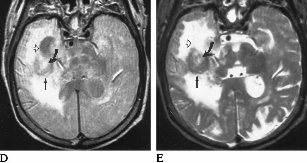 The lesion (open arrow) is immediately posterior and superior to the ventricle and is not well demarcated from the adjacent edematous white matter.