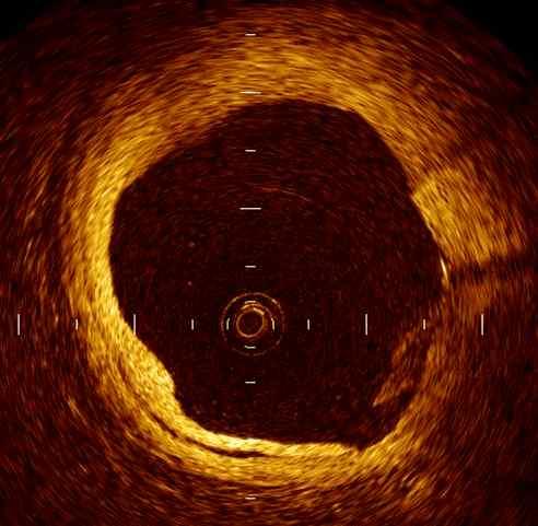 OCT and IVUS