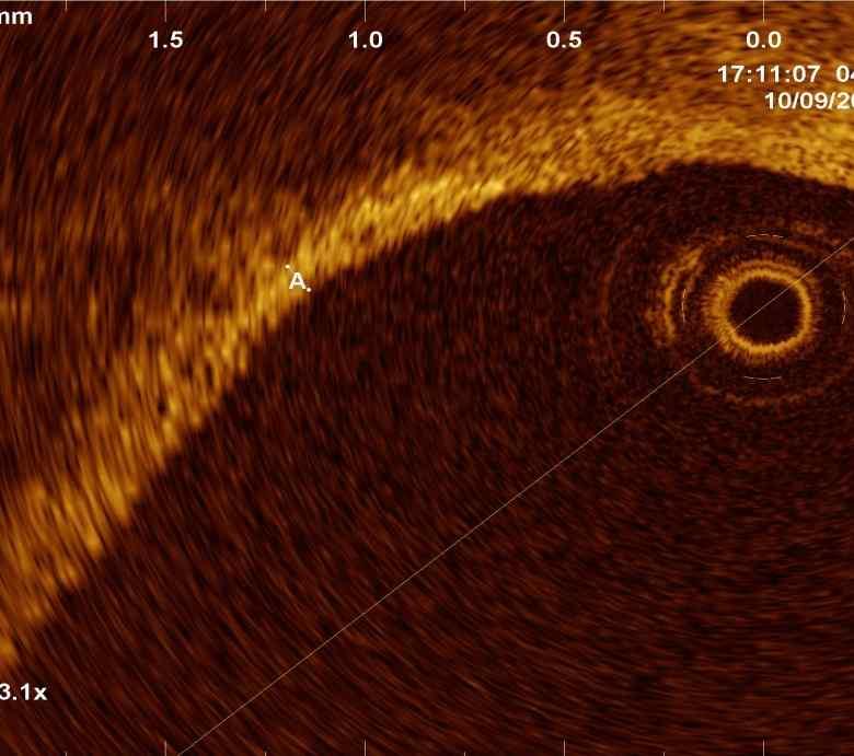 primary PCI Total atheroma