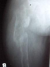 osteoporosis and multiple lytic expansile lesions in the iliac bones and proximal femur Discussion Figure 7.