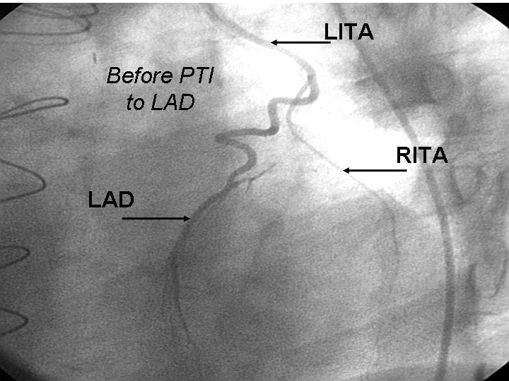 Internal Thoracic Artery (RITA) graft between