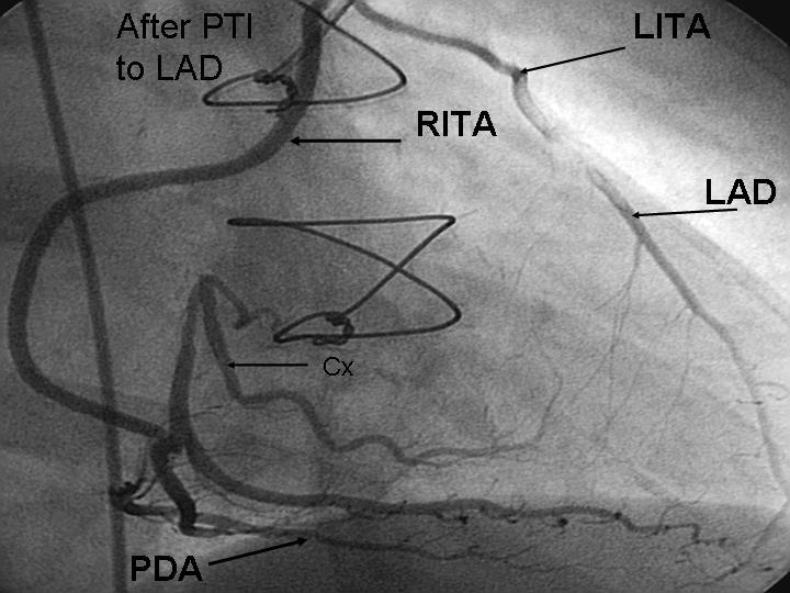 Six years after surgery: Injection to LITA graft demonstrating patent Right Internal Thoracic Artery (RITA) graft to Circumflex
