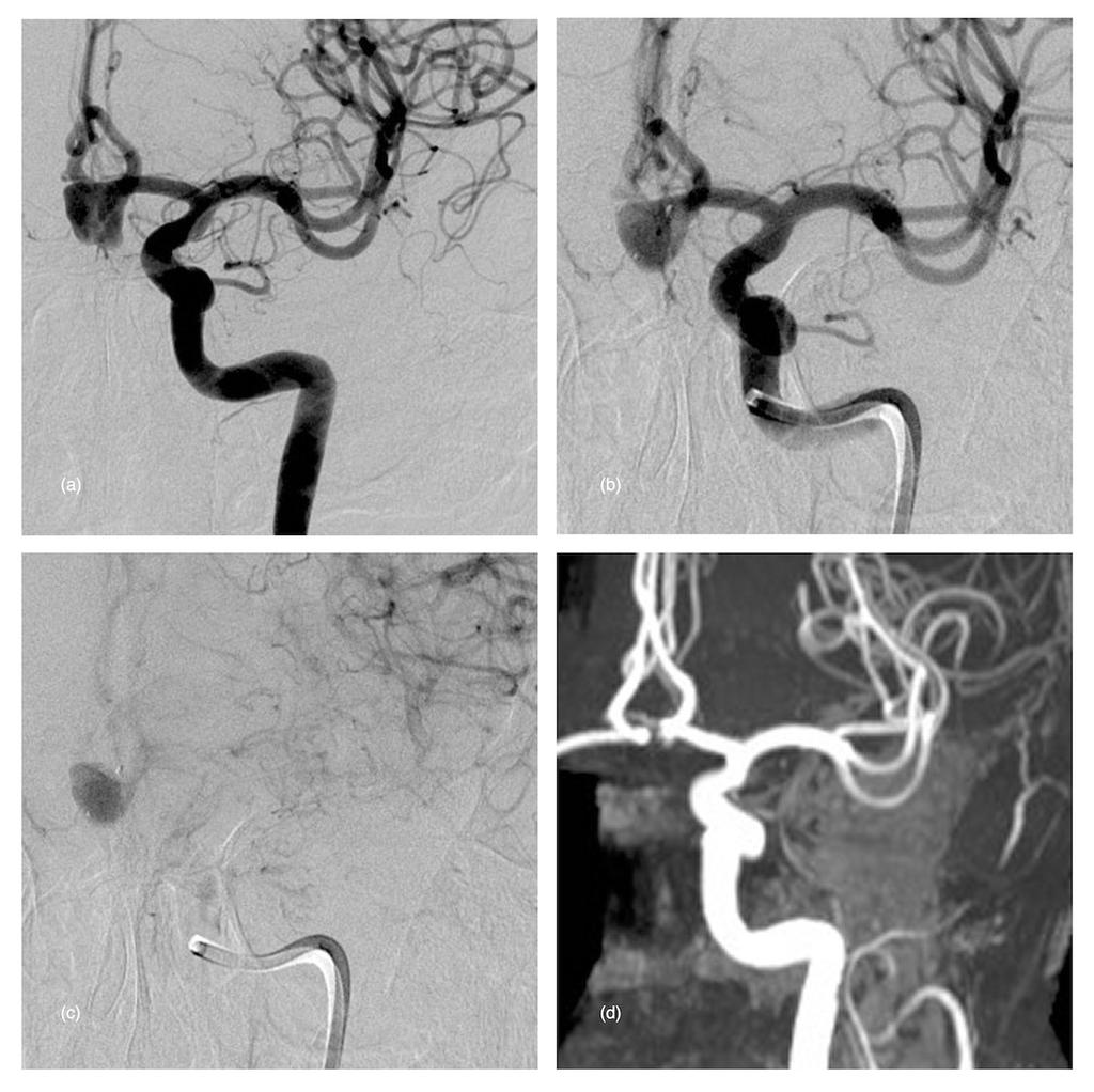 Role, safety, and efficacy of WEB flow disruption: a review Figure 3 - Unruptured Acom aneurysm in a 60-year old male treated with a WEB-SLS device.