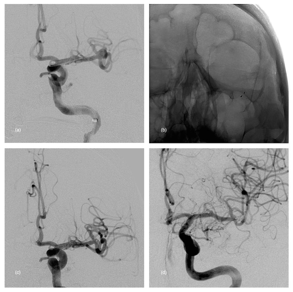 Role, safety, and efficacy of WEB flow disruption: a review Figure 4 - Unruptured MCA aneurysm in a 45-year old female. (a) Preoperative DSA (working view) showing the wide-neck MCA aneurysm.