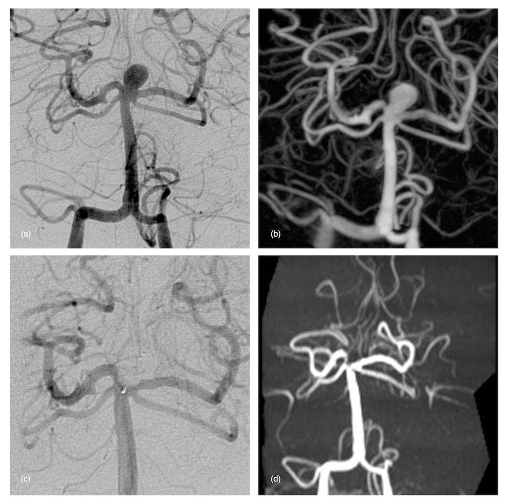 (a) & (b) Frontal preoperative DSA (2D and 3D) showing a wide-neck basilar aneurysm.