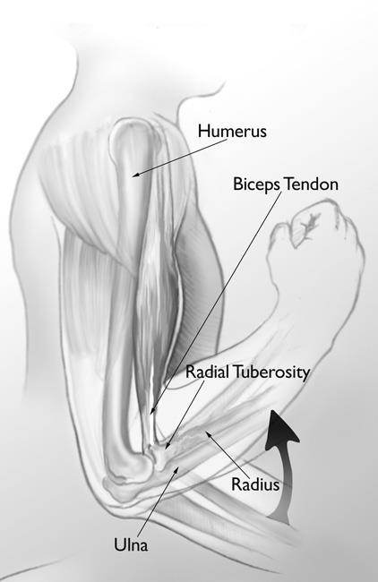The biceps muscle helps you bend and rotate your arm. It attaches at the elbow to a small bump on the radius bone called the radial tuberosity.